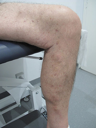 Patient-1)-Phlebectomy-and-Sclerotherapy-6-months-post-(1)