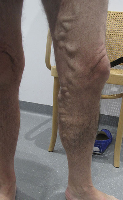 Patient-1)-Phlebectomy-and-Sclerotherapy-before-procedure
