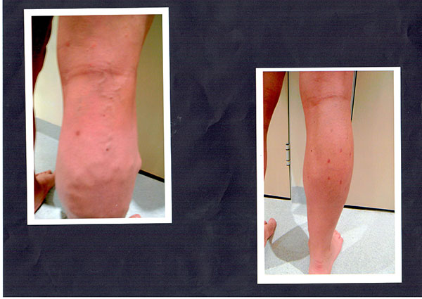 Patient-3)-Phelbectomy-and-Sclerotherapy-Before-and-9-months-Post-(1)