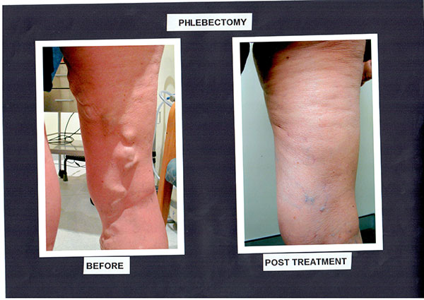 Patient-4)-Phlebectomy-and-Sclerotherapy-Before-and-After-Procedure-(1)