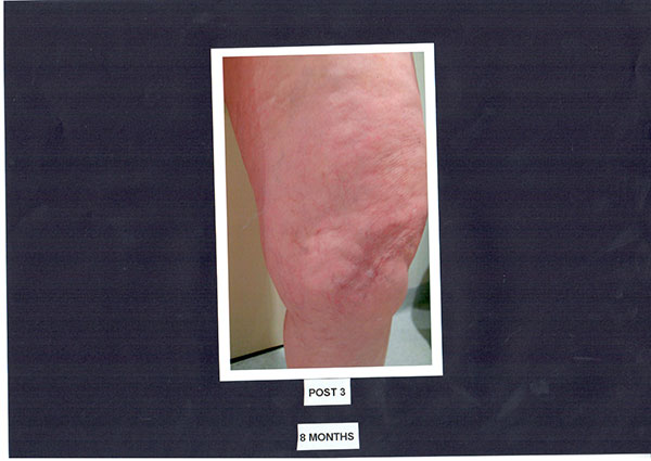 Patient-1)-Sclerotherapy-8-months-post-(1)