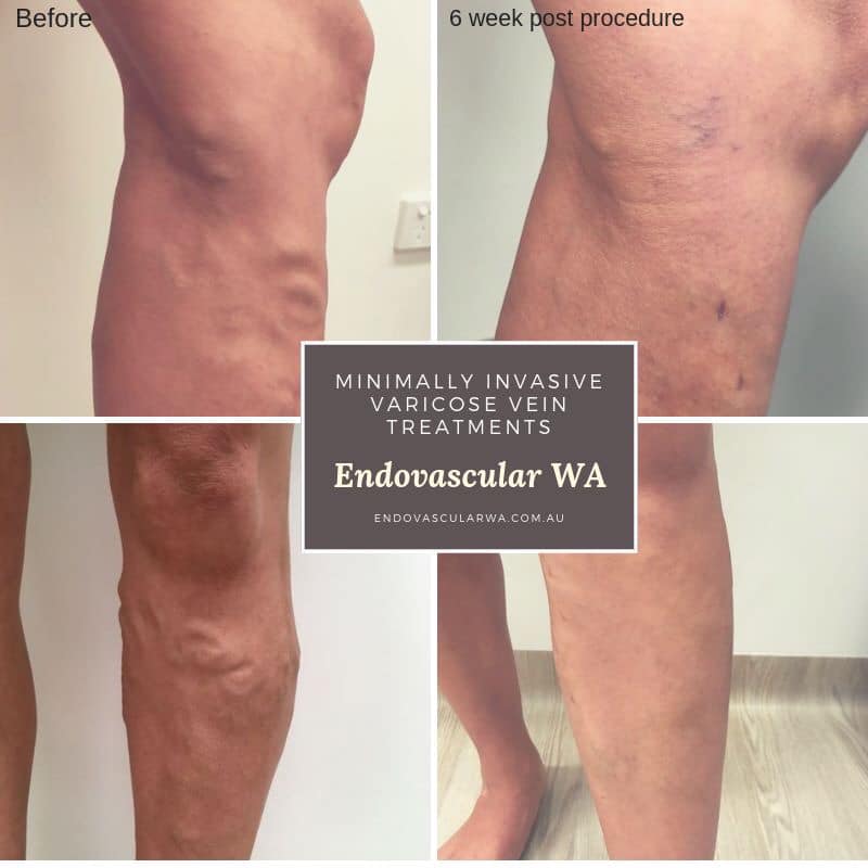 Varicose_Vein_Before_And_After