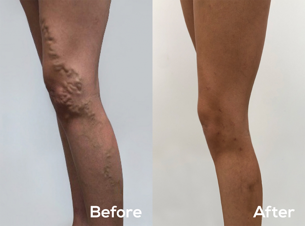 Endovascular WA before and after varicose vein treatment 25 year old woman