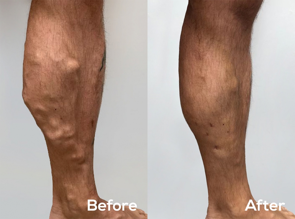 Endovascular WA before and after varicose vein treatment 41 year old male saphenous vein