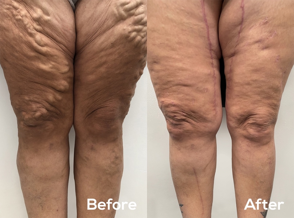 Endovascular WA before and after varicose vein treatment 43 year old woman