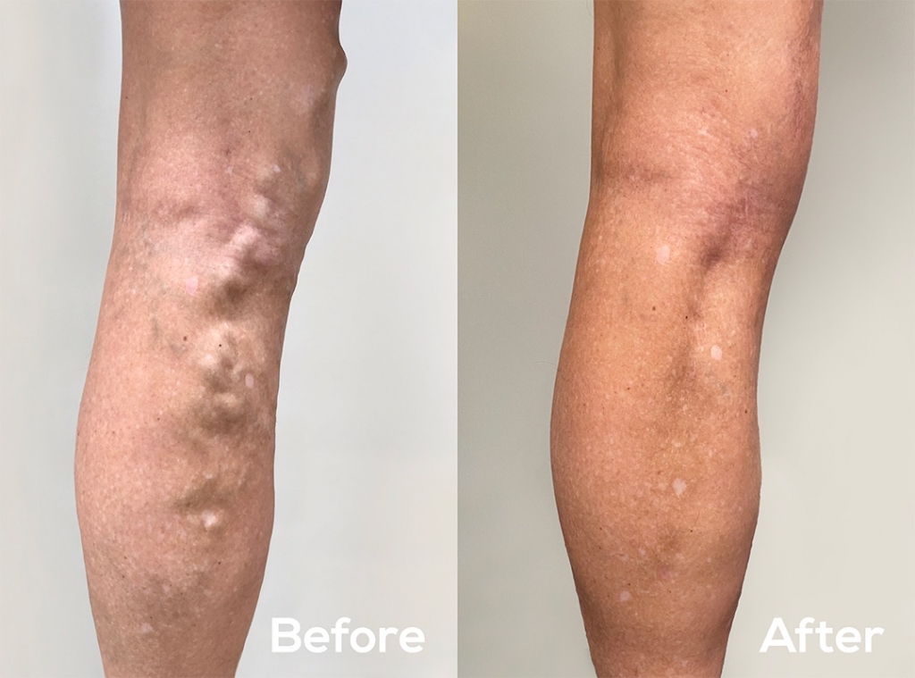 Endovascular WA before and after varicose vein treatment 60 year old woman
