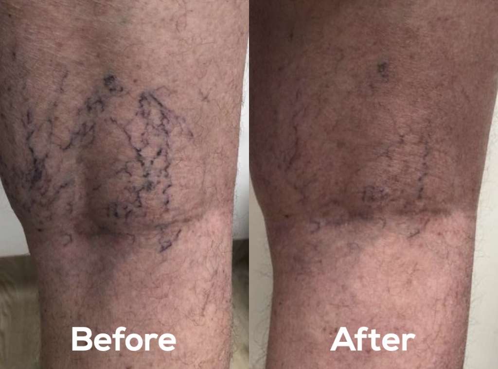 Endovascular WA before and after varicose vein treatment spider veins